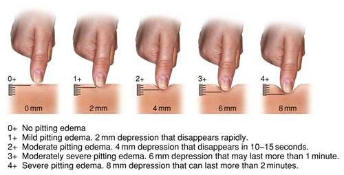 Oedema rating scale